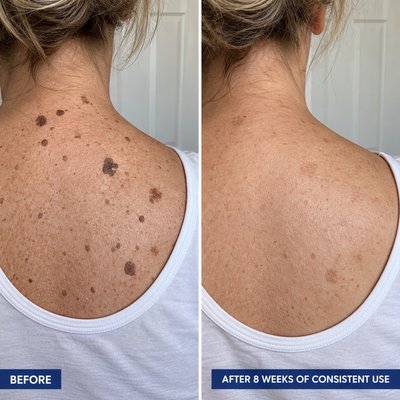 Cerva - Keratolytic Cream For Rough & Raised Seborrheic Keratoses
